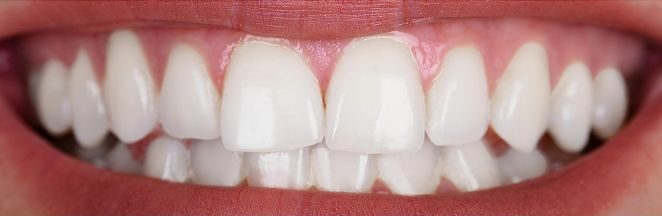 After photo of Invisalign treatment