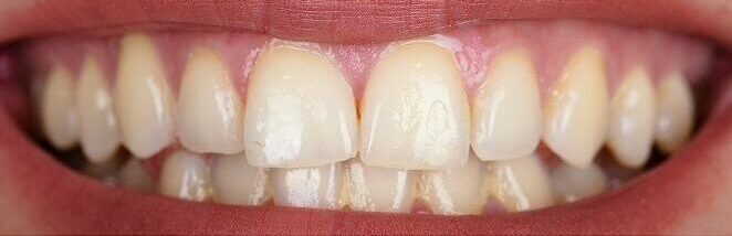 Before photo of Edmonton Invisalign treatment